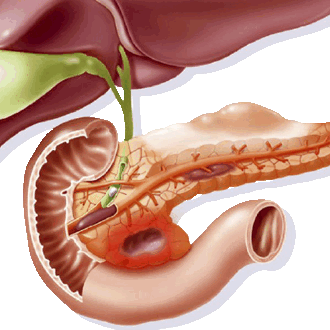Рак внепеченочных желчных протоков