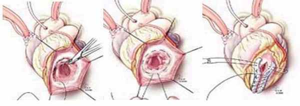 Кисетная пластика по Жатене (Jatene).jpg
