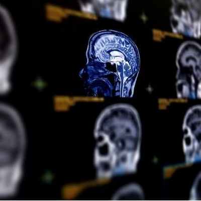 Аневризма сосудов головного мозга