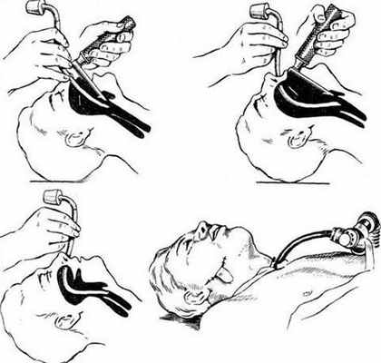 Осложнения интубации трахеи