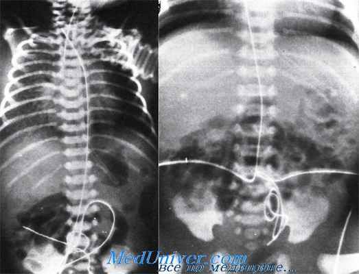 осложнения катетеризации пупочной артерии
