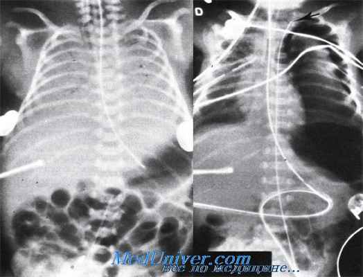 осложнения катетеризации пупочной артерии