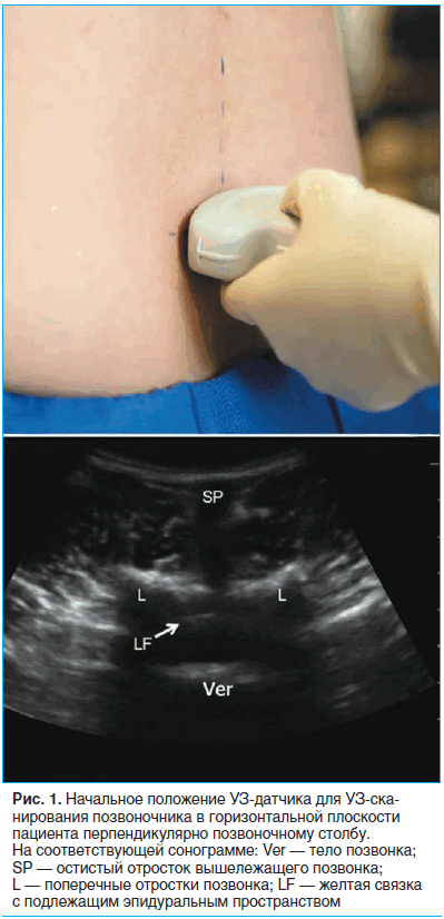 Рис. 1. Начальное положение УЗ-датчика для УЗ-сканирования позвоночника в горизонтальной плоскости пациента перпендикулярно позвоночному столбу.