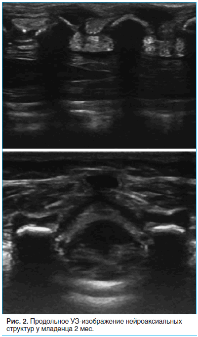 Рис. 2. Продольное УЗ-изображение нейроаксиальных структур у младенца 2 мес.
