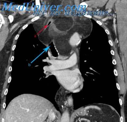 операции на средостении