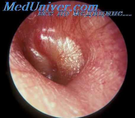 трудности парацентеза