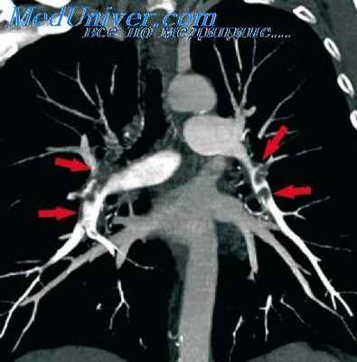 прескаленная биопсия