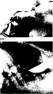 Положение больного и место разреза при медиастиноскопии