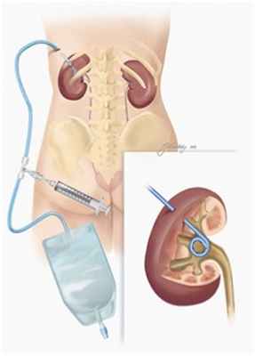 Описание: Нефростомия. Типы нефростомических катетеров.