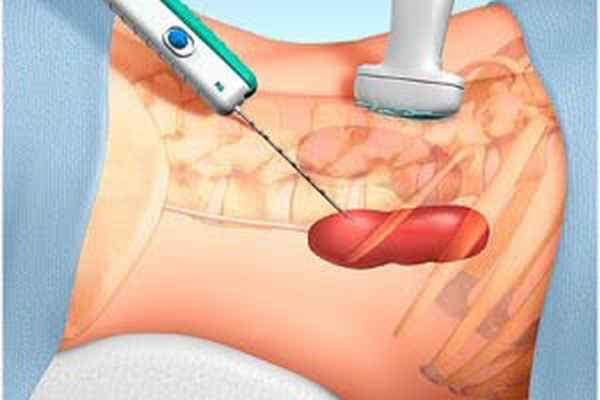 Пункционная биопсия почки