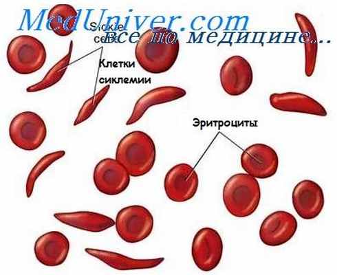 серповидно-клеточная анемия