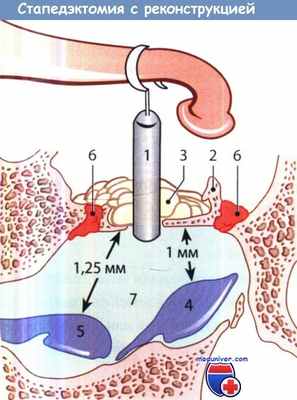 Стапедэктомия