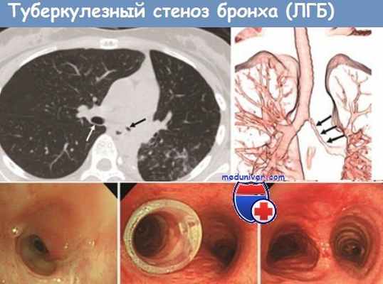 туберкулез бронха