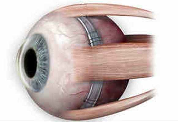 Эписклеральное пломбирование сетчатки