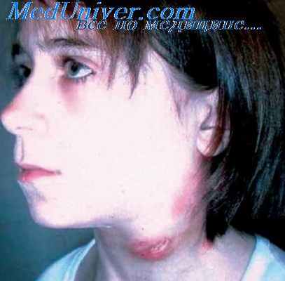 туберкулезный мезаденит