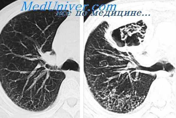 бронхоскопия