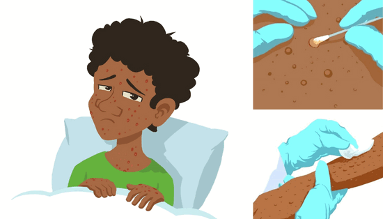 Оспа обезьян: вводный курс в связи со вспышкой заболевания в Африке