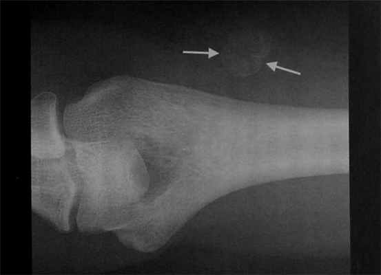 Снимки МРТ и КТ. Оссифицирующий миозит