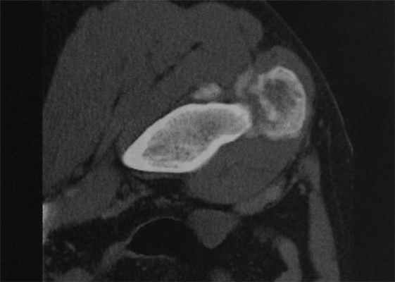 Снимки МРТ и КТ. Оссифицирующий миозит
