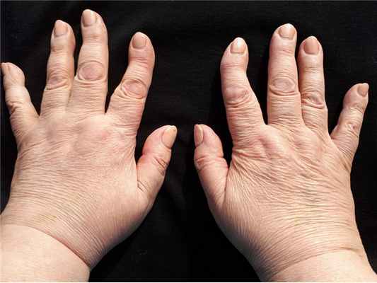 Остеоартроз