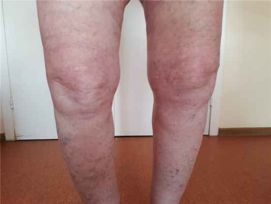 Остеоартроз