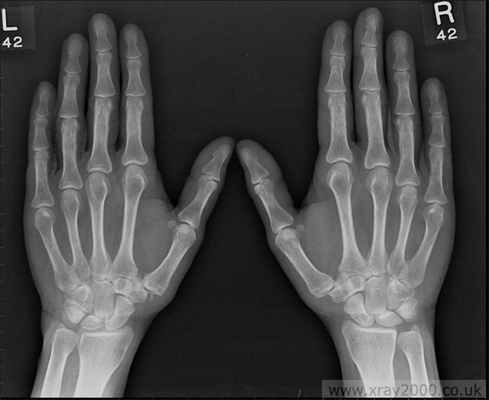 Остеоартроз