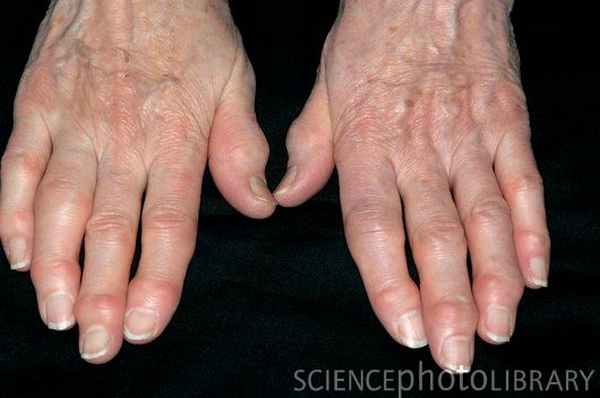 Остеоартроз