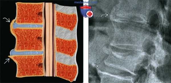 Остеоартроз осевого скелета - лучевая диагностика