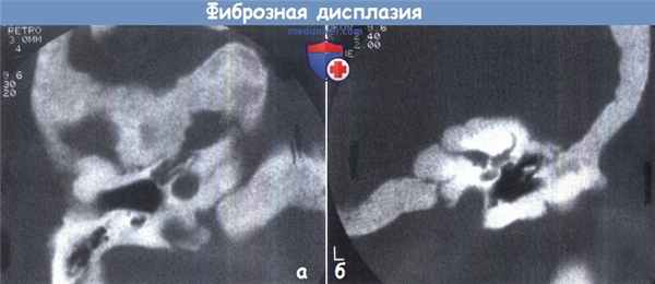 Фиброзная дисплазия височной кости