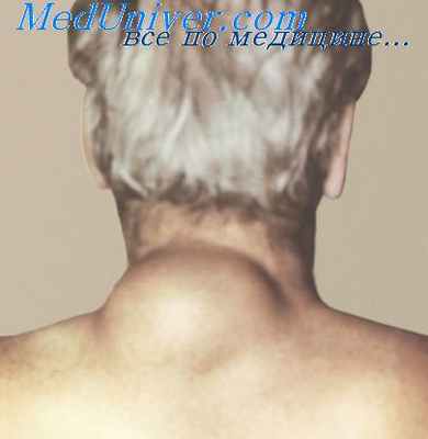 остеолипома