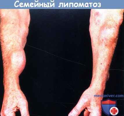 Семейный липоматоз