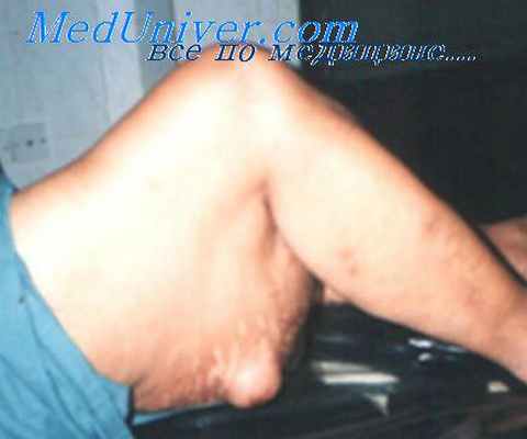 липома передней стенки живота