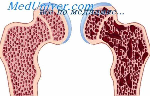 остеоартрит