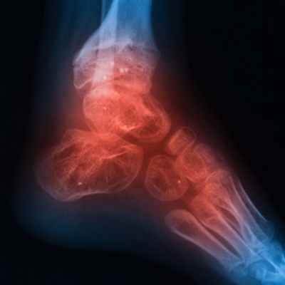 Остеомиелит