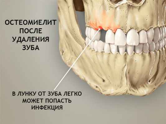 остеомиелит челюсти