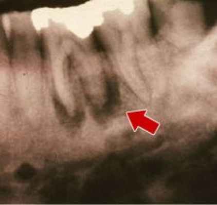 остеомиелит челюсти