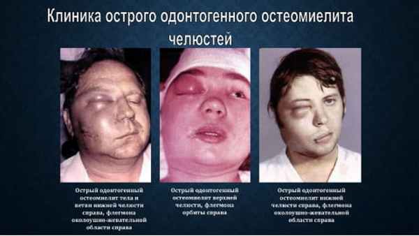 остеомиелит челюсти