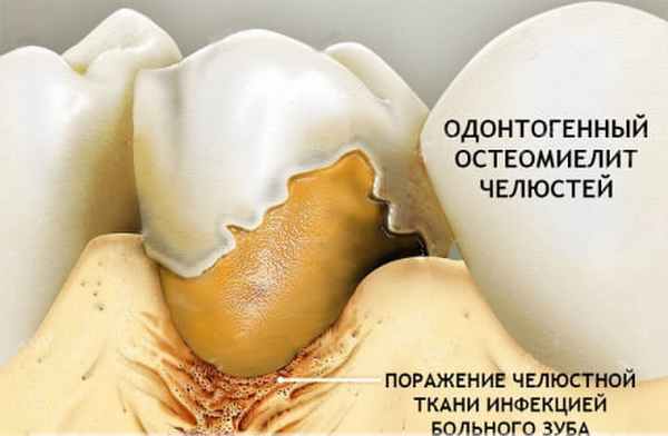 остеомиелит челюсти