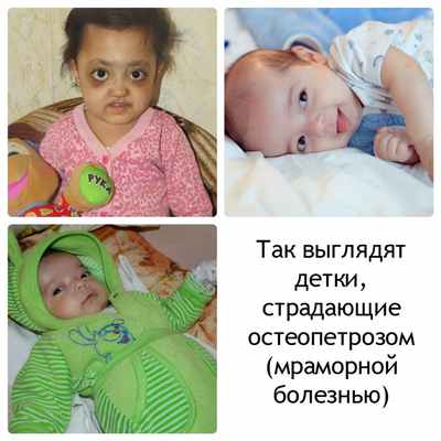 остеопетроз