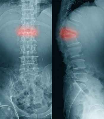 Компрессионный перелом.jpg