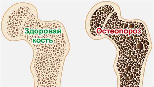 Остеопороз