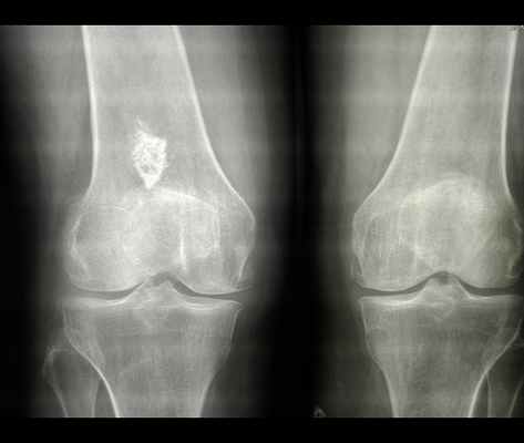 Как выглядит остеосклероз на рентгене