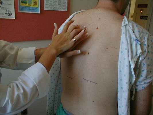 Благодаря перкуссии остистых отростков также можно диагностировать состояние позвоночника