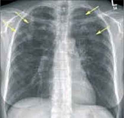 Эозинофильная пневмония
