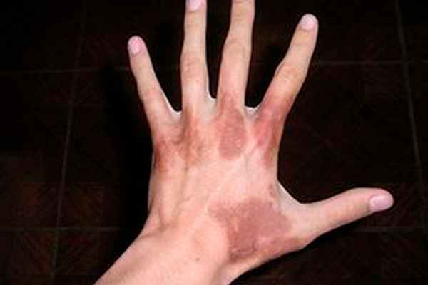 Фотодерматозы