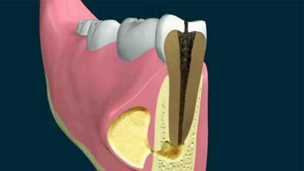 апикальный периодонтит