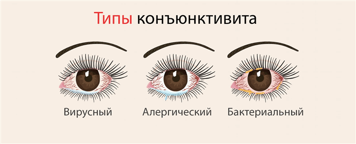 Типы конъюнктивита