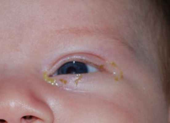 острый конъюктивит