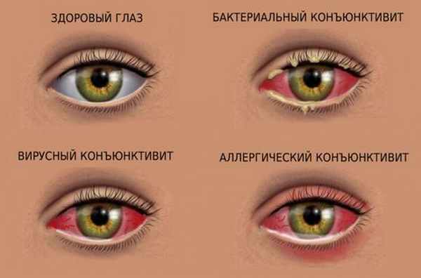 острый конъюктивит