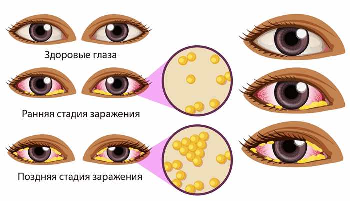 Стадии развития бактериального конъюнктивита